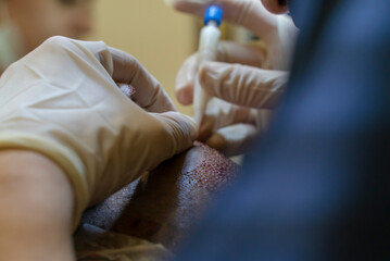 DHI Hair Transplant timelapse Baldness treatment. Hair transplant. HAIR TRANSPLANT - FUE - DHI -...