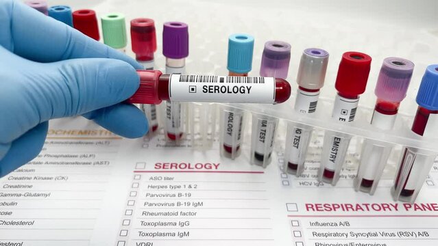Doctor working with blood sample for Serology diagnosis in the lab. Blood drawn from a patient for Serology analysis samples in the laboratory
