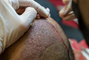 DHI Hair Transplant timelapse Baldness treatment. Hair transplant. HAIR TRANSPLANT - FUE - DHI -...