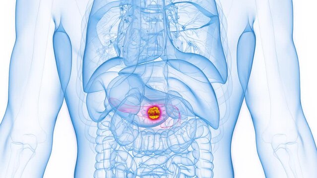 3d rendered medical animation of a cancerous pancreatic mass in a human male