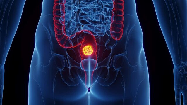 3d rendered medical animation of a malignancy in a man's rectum