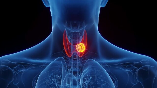 3d rendered medical animation of thyroid cancer in the right thyroid lobe