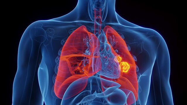 3d rendered medical animation of lung cancer in a human male