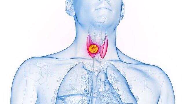 3d rendered medical animation of a cancerous tumor in a man's thyroid gland