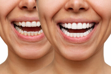 Cropped shot of a young caucasian smiling woman before and after veneers installation on a white...