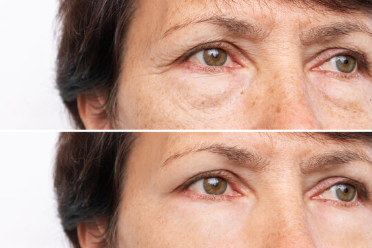 Two shots of an elderly woman's face with puffiness under her eyes and wrinkles before and after treatment. Age-related skin changes. Result of blepharoplasty, plastic surgery