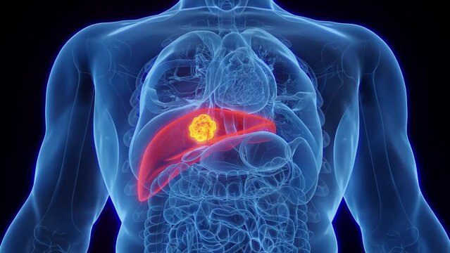 3d rendered medical animation of malignant mass in a man's liver
