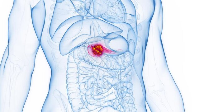 3D rendered Medical Animation of pancreatic cancer in a male human