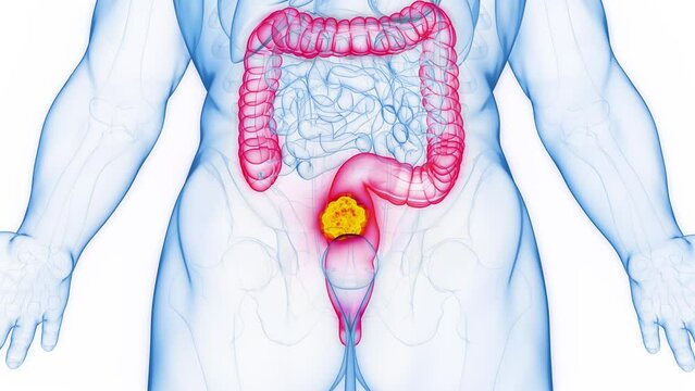3D rendered medical animation of a malignant growth in a man's rectum.