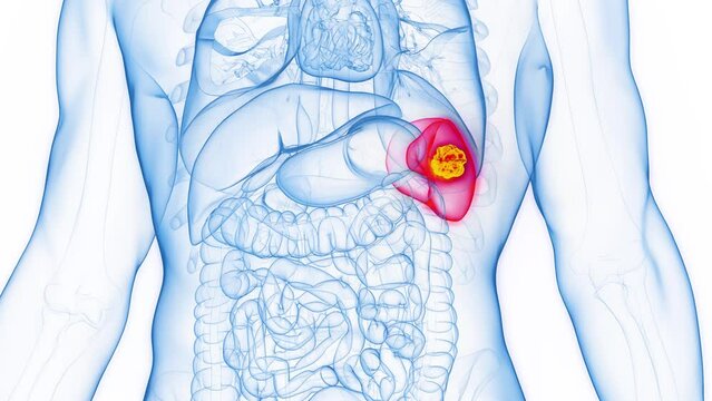 3D rendered Medical Animation of a cancerous tumor in the spleen of a man.