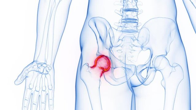 3D rendered Medical Animation of a man's inflamed left hip.