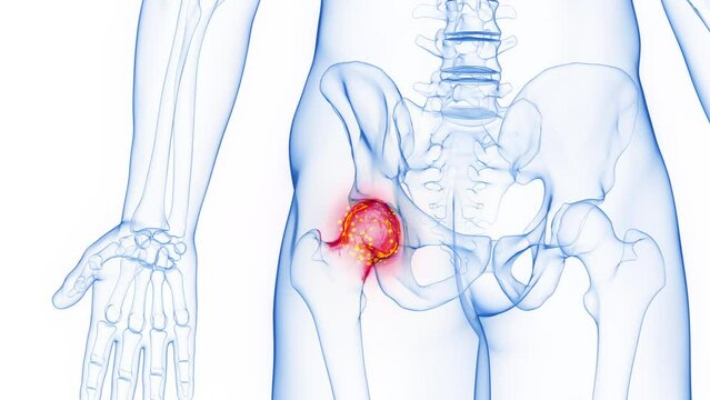 3D rendered Medical Animation of a man's inflamed left hip joint.
