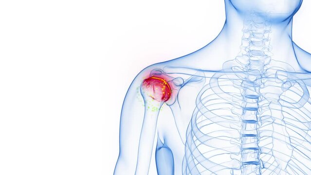 3D rendered Medical Animation of inflammation of a man's right shoulder joint.