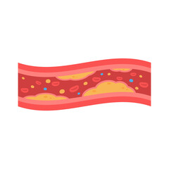 coronary arteries with accumulated fat in the body