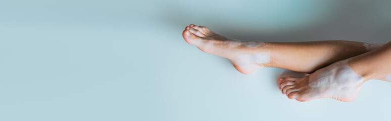 cropped view of woman with vitiligo and bare feet on grey background, banner.