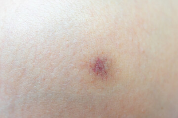 Fototapeta premium Close-up of a small bruise on a human body