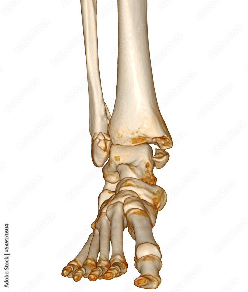 Poster ct scan ankle and foot or computed tomography of ankle joint and foot 3d volume rendering image show