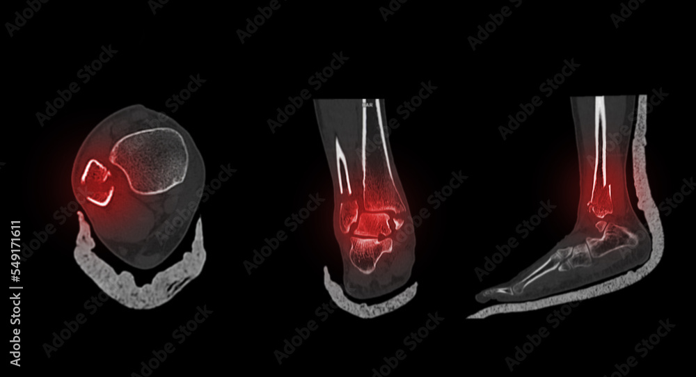 Poster ct scan ankle and foot or computed tomography of ankle joint and foot 3d volume rendering image show