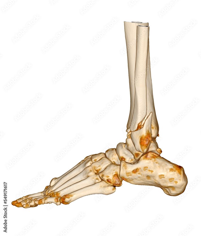 Poster ct scan ankle and foot or computed tomography of ankle joint and foot 3d volume rendering image show