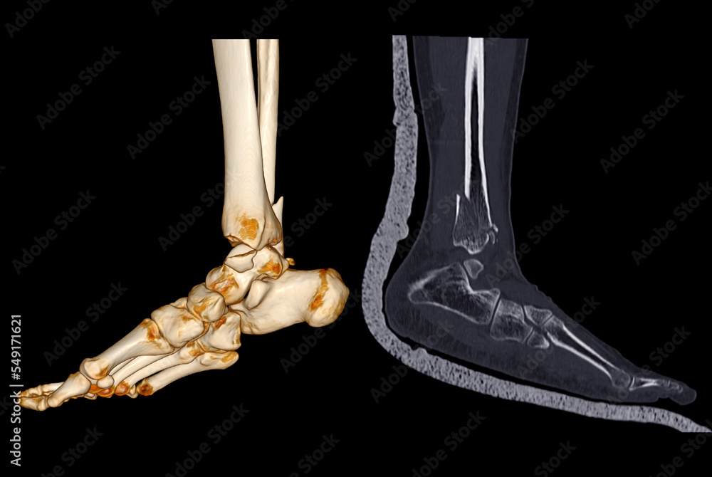 Poster ct scan ankle and foot or computed tomography of ankle joint and foot 3d volume rendering image show