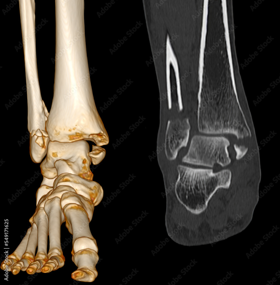 Poster ct scan ankle and foot or computed tomography of ankle joint and foot 3d volume rendering image show