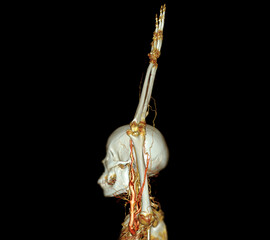 Brachial Arteries of the arm with Upper extremity Bone 3D rendering from CT Scanner.