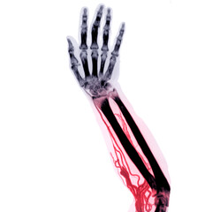 Brachial Arteries of the arm with Upper extremity Bone 3D rendering from CT Scanner.