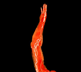 Brachial Arteries of the arm with Upper extremity Bone 3D rendering from CT Scanner.