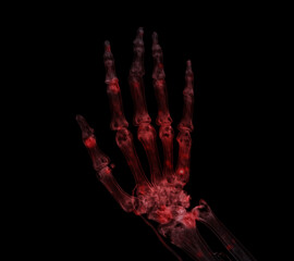 Hand 3D rendering for rheumatoid arthritis Concept.