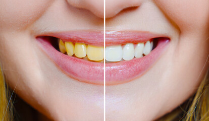 close-up. a woman's smile with a comparison of whitened and yellow teeth. 