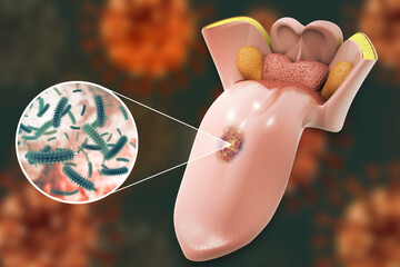 Tongue cancer medical concept or squamous cell carcinoma as malignant tumor disease. 3d illustration - obrazy, fototapety, plakaty