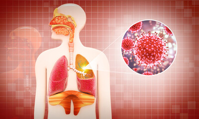 Lung infection caused by bacteria or virus, Bacterial pneumonia medical concept, 3d illustration