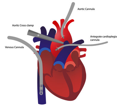 Cannulated Heart for a open chest cardiac surgery. Cardiopumonary bypass system cannula positioned