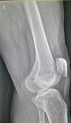 Rayos x o radiografía de rodilla  don de sen las cabezas del  fémur y tibia y la rotula. © Tonikko