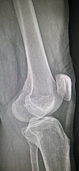 Rayos x o radiografía de rodilla  don de sen las cabezas del  fémur y tibia y la rotula. © Tonikko
