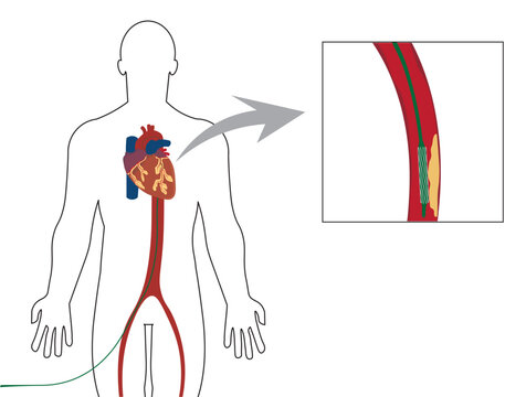Cardiac Catheterization illustration. Illustration of a catheterization prodcedure with a plaquete in a artery in the heart