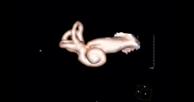 MRi BRAIN and ICA or internal auditory canal 3D rendering.