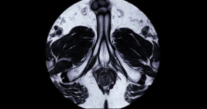 MRI prostate gland in aged mens for diagnosis prostate cancer cell .