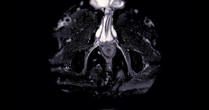 MRI prostate gland in aged mens for diagnosis prostate cancer cell .