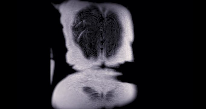 MRI Upper Abdomen  for diagnosis Liver tumor or Hepatocellular carcinoma ( HCC ).