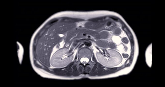 MRI Upper Abdomen  for diagnosis Liver tumor or Hepatocellular carcinoma ( HCC ).