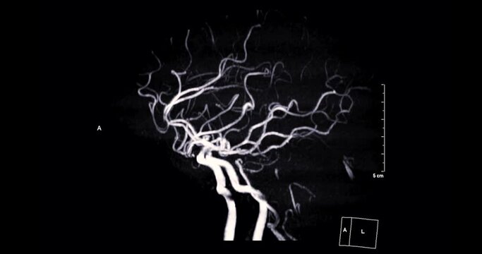 MRA Brain or Magnetic resonance angiography of Cerebral artery in the brain .