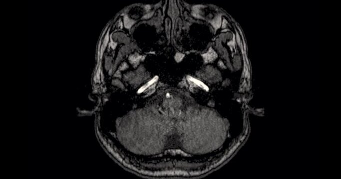 MRA Brain or Magnetic resonance angiography of Cerebral artery in the brain axial view.