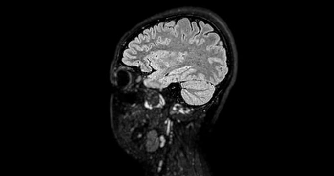MRI Brain Sagittal Flair 3D can help doctors look for conditions such as bleeding, swelling, tumors, infections, inflammation, damage from an injury or a stroke diseases.
