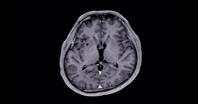 MRI Brain axial flair  can help doctors look for conditions such as bleeding, swelling, tumors, infections, inflammation, damage from an injury or a stroke diseases.