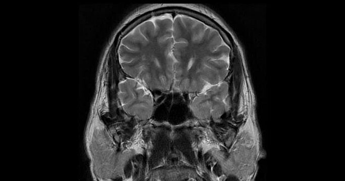 MRI Brain can help doctors look for conditions such as bleeding, swelling, tumors, infections, inflammation, damage from an injury or a stroke diseases.