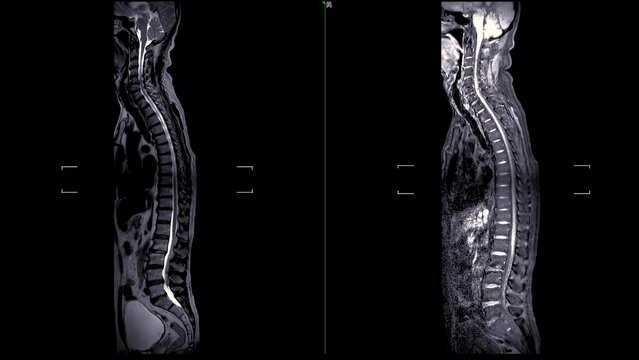 MRI Screening whole spine  sagittal T2 and T1 FS showing  spine compress spinal cord ( Myelopathy )