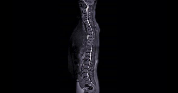 MRI Screening whole spine  sagittal T2 FS showing  spine compress spinal cord ( Myelopathy )