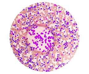 Blood smear under microscopy showing chronic lymphoblastic leukemia (CLL)
