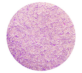 Blood smear under microscopy showing chronic lymphoblastic leukemia (CLL)